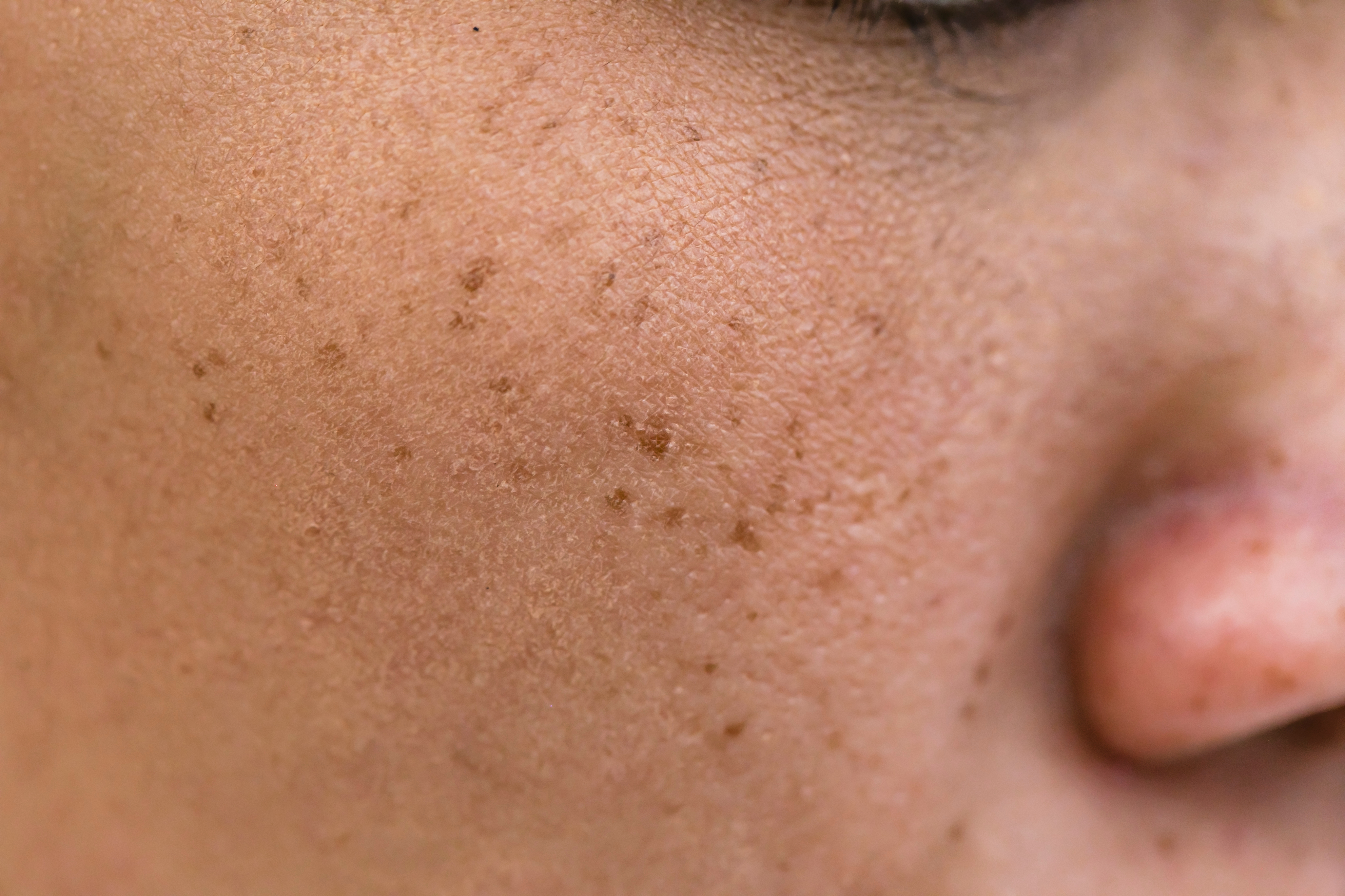 Abstehender leberfleck